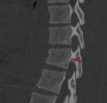 Spinous Process Fracture